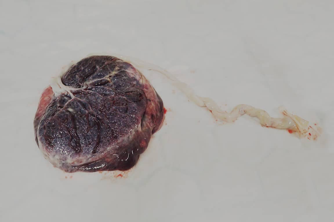 A photograph of a placenta laid out on a white mat