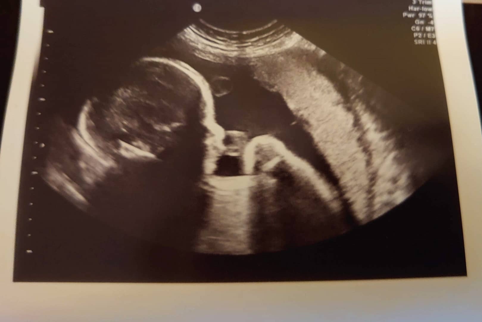 An ultrasound scan of a baby in the womb
